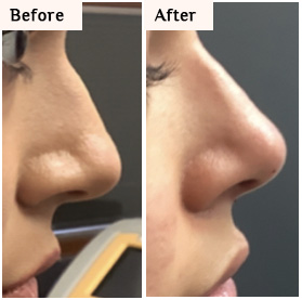 before and after nose reshape sculptra